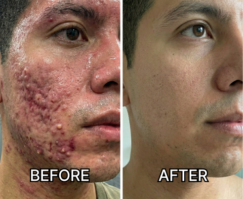 10 Reasons Why This Sun Serum Stops Acne Before It Starts