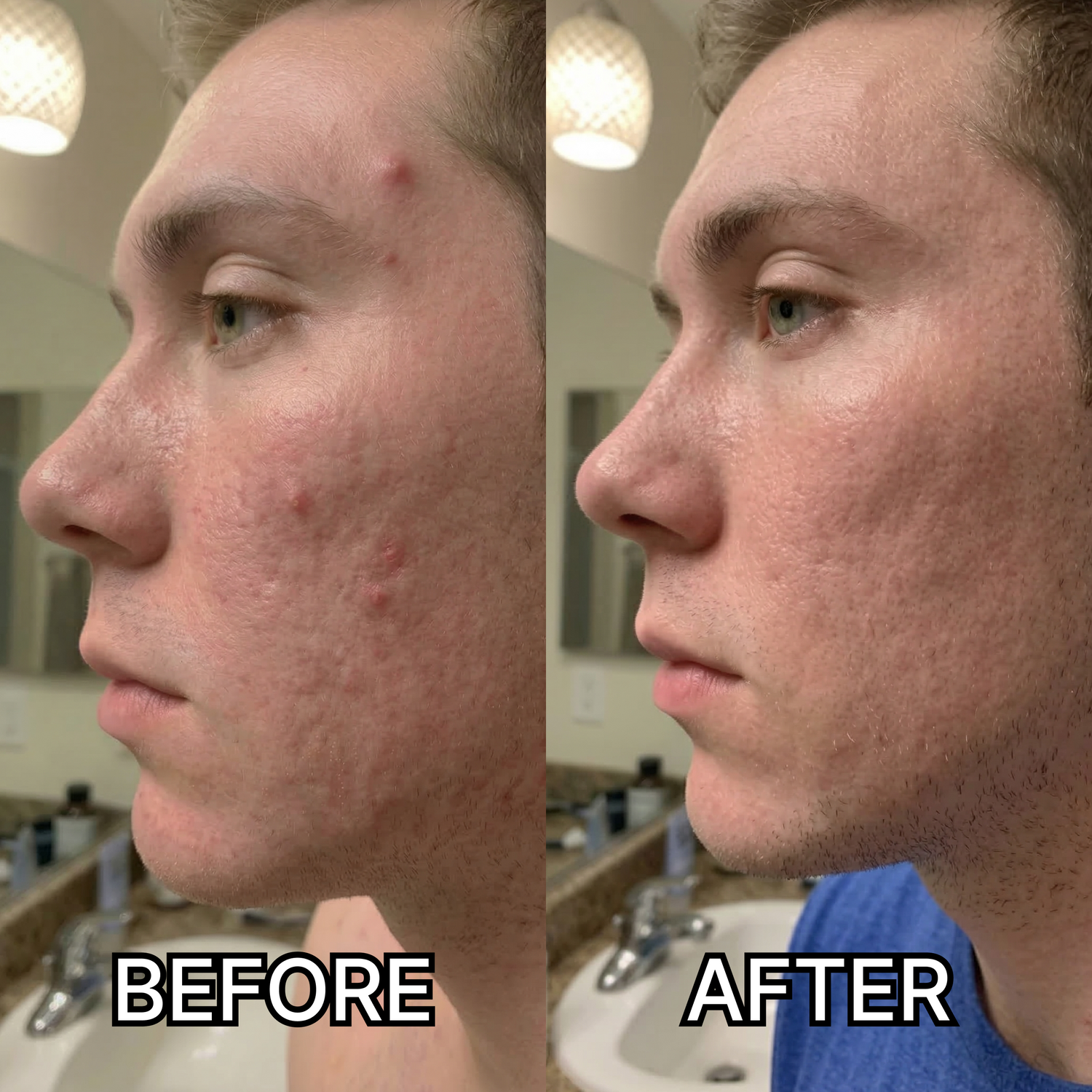 6 Reasons This Toner Works When “Acne Products” Don’t