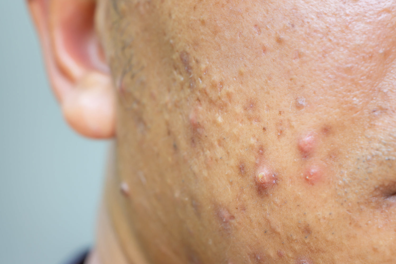 How to Choose Non-Irritating Cooling Products for Sensitive Skin